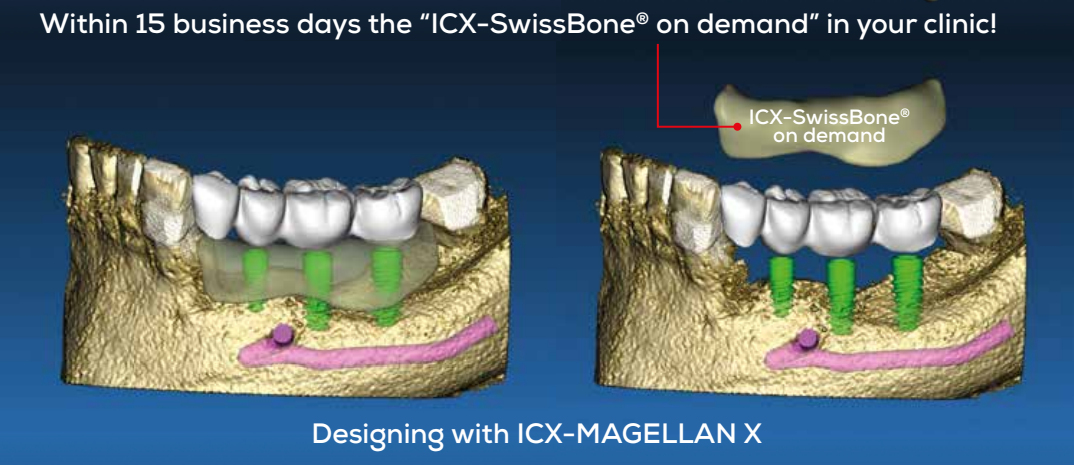 ICX-Swiss Bone on demand