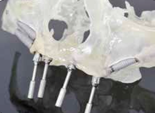 ICX-MULTI® ABUTMENTS