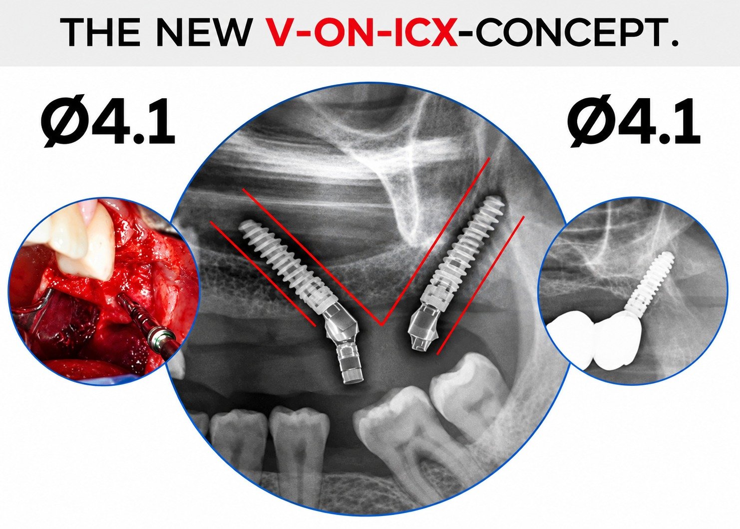 ICX Tuber Implant