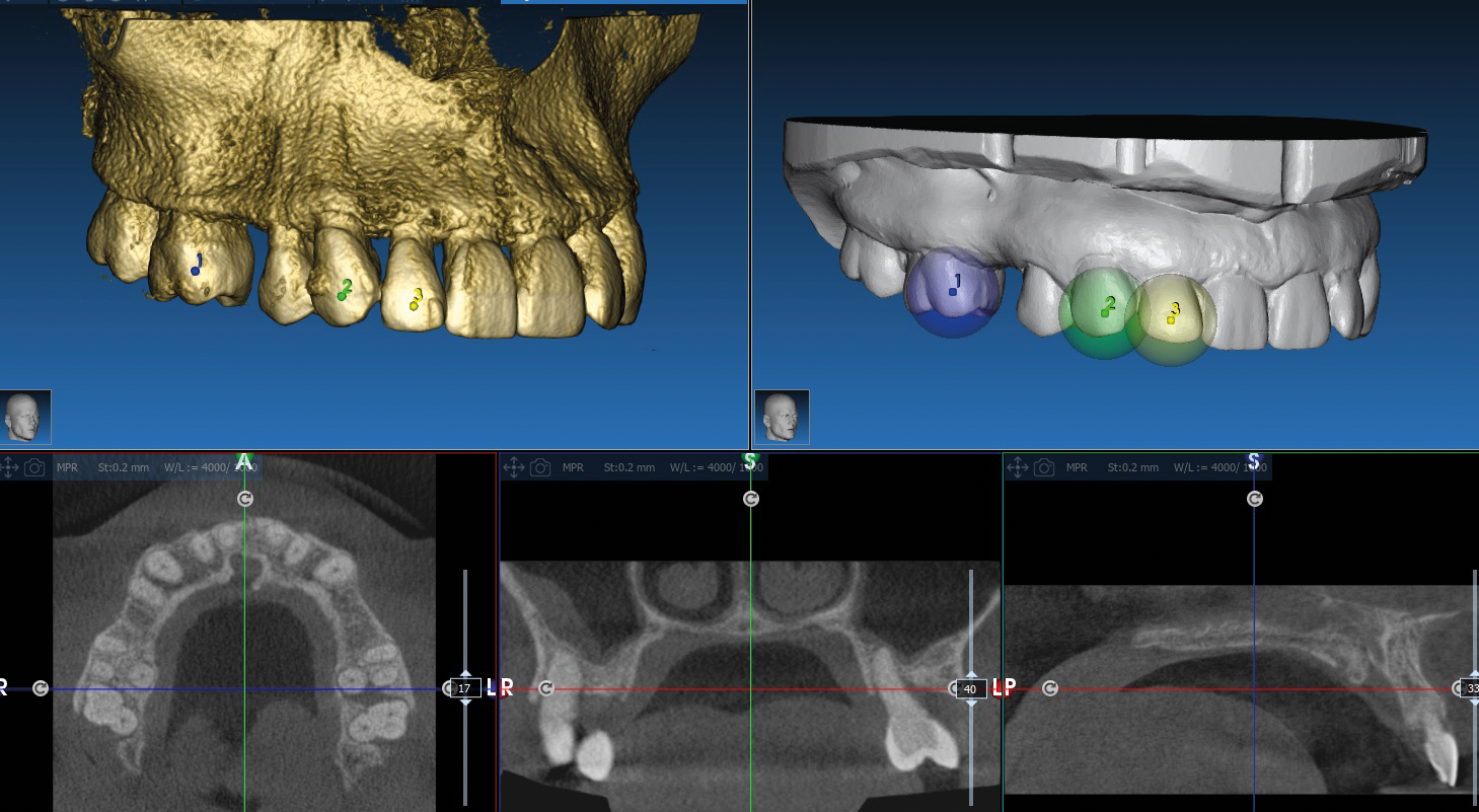 ICX-P5 Intraoral Scanner